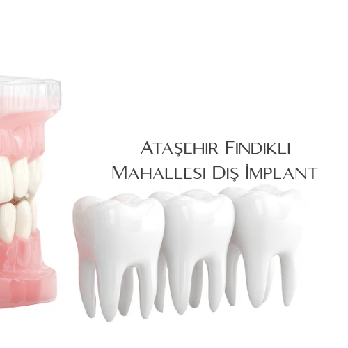 Ataşehir Fındıklı Mahallesi Diş İmplant