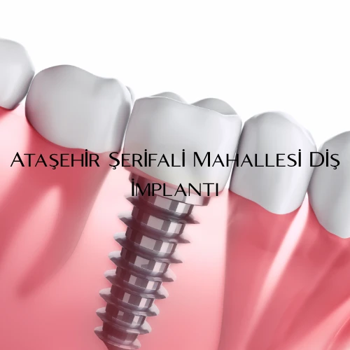 Ataşehir Şerifali Mahallesi Diş İmplantı