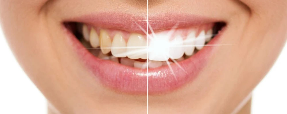 Profesyonel beyazlatma ile parlak gülüşler